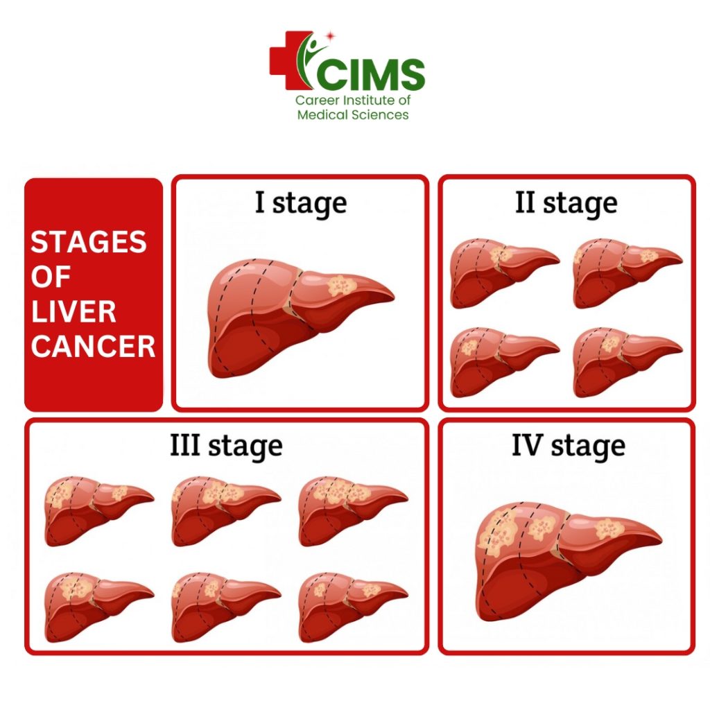 Liver cancer pictures