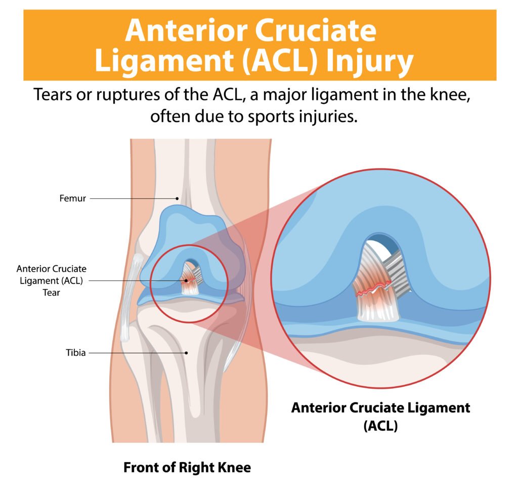 Knee Ligament Surgery