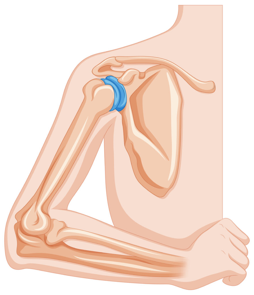 Reverse Shoulder Replacement