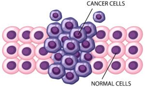 What is the Difference Between Tumor and Cancer