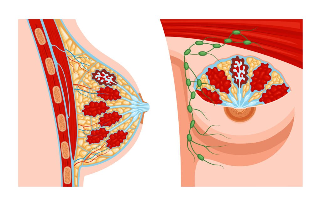 Breast Cancer Symptoms in Hindi