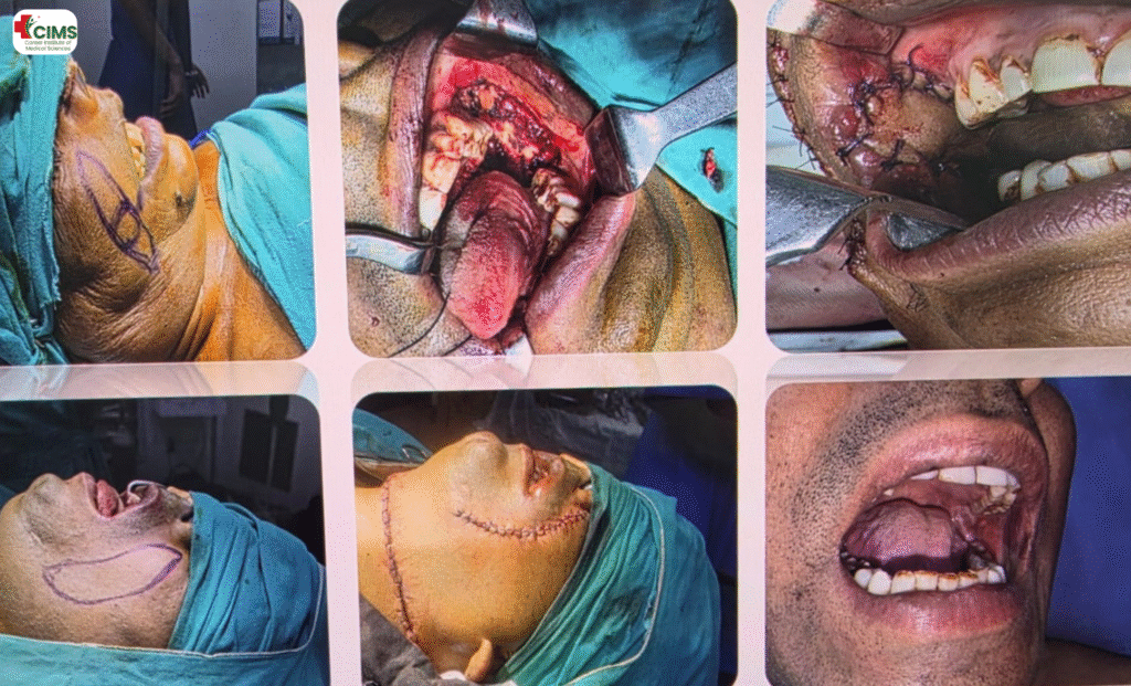 सिर और गर्दन के कैंसरसिर और गर्दन के कैंसर Head and Neck Oncology in Bhopal