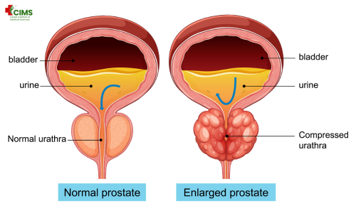 Prostate Cancer in Hindi
