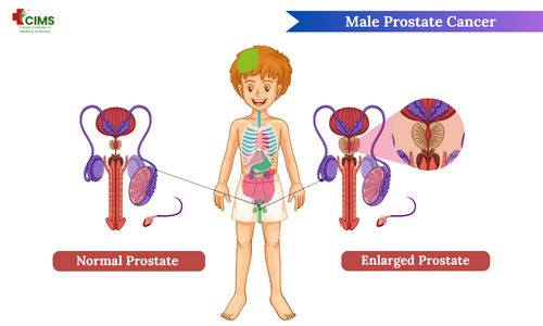 Prostate Cancer in Hindi