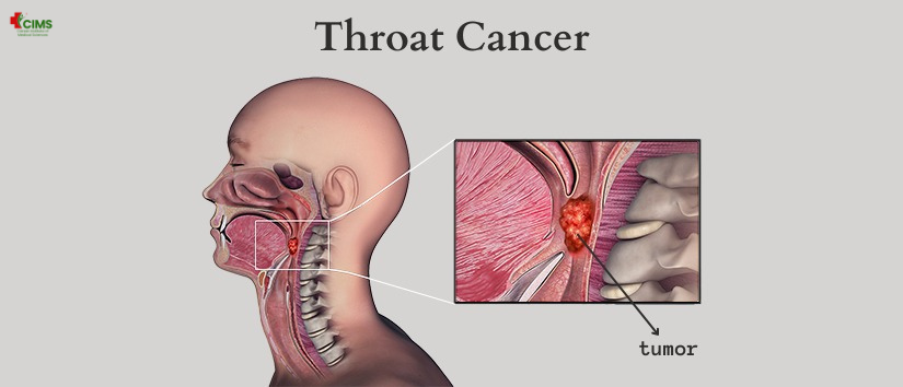 Throat Cancer Symptoms