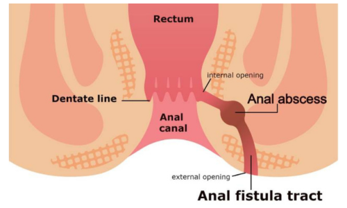 Fistula Surgery