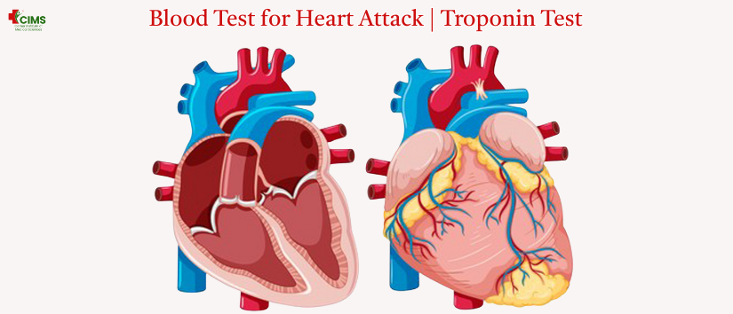 Blood Test for Heart Attack | Troponin Test